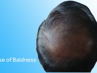 What causes baldness?