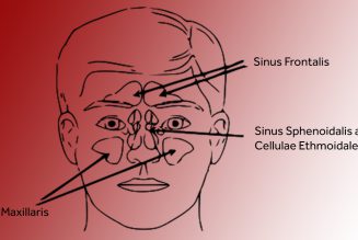Sinus Headache – What is it?