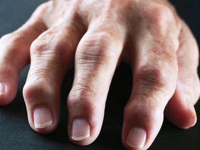 Rheumatoid Arthritis – RA