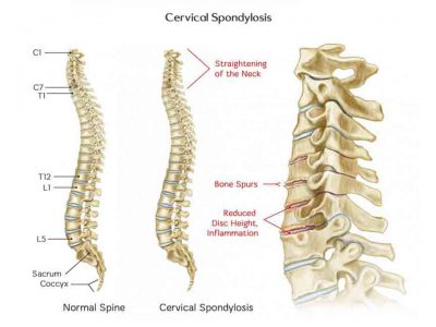 Yoga for Cervical Spondylosis