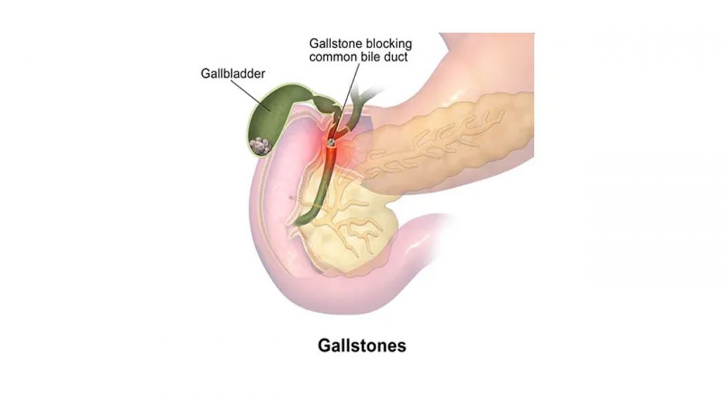 Gallbladder Stone